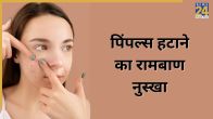 Pimple Home Remedies