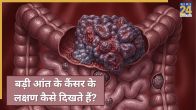 Colorectal Cancer Symptoms