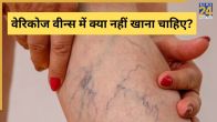 Varicose Veins Symptoms