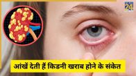 Kidney Damage Signs