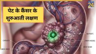 Stomach Cancer