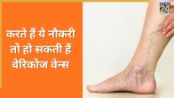 Varicose Veins