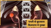 Kidney Stone