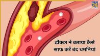 Blocked Arteries
