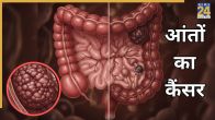 Colon Cancer