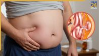 Hernia