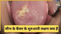 Tongue Cancer