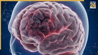 Brain Damage