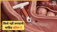 Copper T IUD