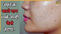 Dark Spots on Face