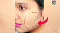 Hair On Cheek
