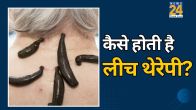 what is leech therapy in ayurveda