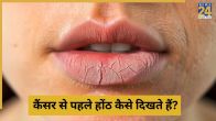 Lip cancer Hona
