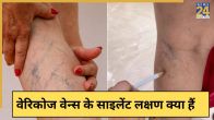 Varicose Veins