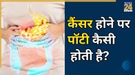 colon cancer constipation