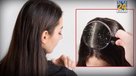 Dandruff Hair