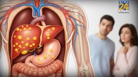 Fatty Liver