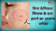 Pimple Marks