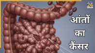 Colon cancer symptoms