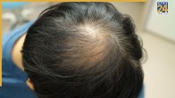 Hair Whorl On Head Meaning