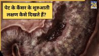 Stomach Cancer Symptoms