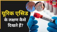 Uric Acid Symptoms