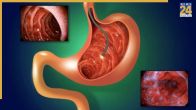 Pet mein Ulcer Hona