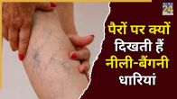 Varicose Veins