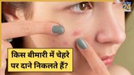Acne Disease Signs