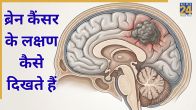 Brain Cancer Symptoms In Hindi