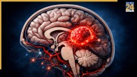 Brain Tumor