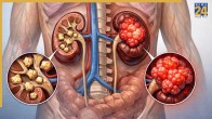 Kidney Stone To Kidney Cancer