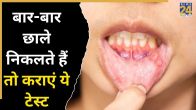 Mouth Ulcer Causes