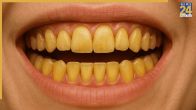Teeth Manjan Hone Par Kya Kare