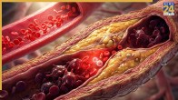 Artery Blockage Foods