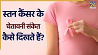Breast Cancer