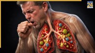 Chest Infection