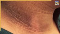 Dark Neck Home Remedies