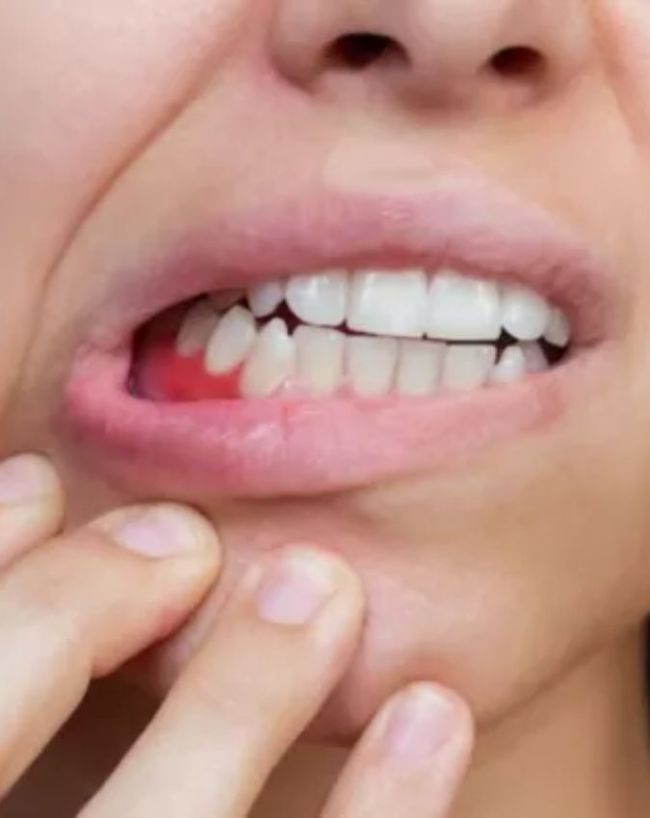मसूड़ों से खून आना