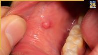 which vitamin deficiency causes mouth ganth
