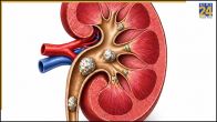 Kidney Stone Symptoms