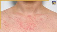 how soon does heat rash go away