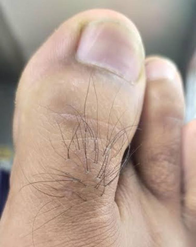 पेरिफेरल एलोपेशिया 