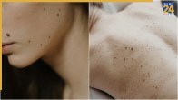 How To Remove Warts At Home Safely