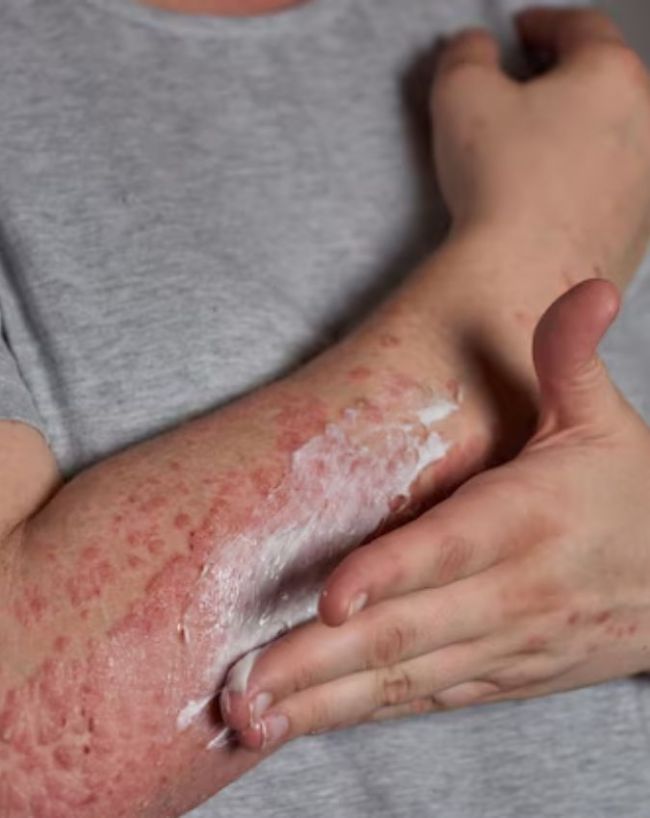 सूजन कम करने में मदद