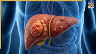 Liver Cancer Ki Stage