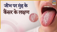 Mouth Cancer Oral Cancer Symptoms