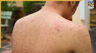 Pimples Causes
