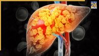 Fatty Liver Healthy Habits: