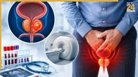 prostate cancer in men